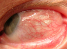 Acute episcleritis in lateral part of left eye September 2005    (self-photo)