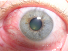 Acute episcleritis in medial (inner) white of left eye October 2005 (self-photo)