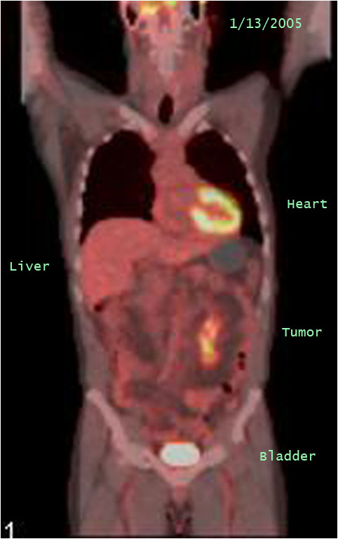 PET/CT 1/13/05 exam, coronal image through tumor