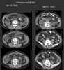 CT Abdomen: Axial images through dominant tumor mass in left abdomen comparing 1/13/2005 and 4/27/2005