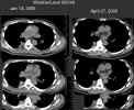 CT Thorax: Axial images through right lower lobe lung lesion comparing 1/13/2005 and 4/27/2005.