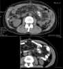 CT axial images through dominant tumor mass in left abdomen comparing 1/13/2005 versus 7/27/2005: Level One