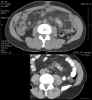 CT axial images through dominant tumor mass in left abdomen comparing 1/13/2005 versus 7/27/2005: Level Two