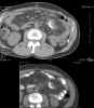 CT axial images through dominant tumor mass in left abdomen comparing 1/13/2005 versus 7/27/2005: Level Three