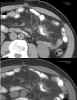 CT Axial images through dominant tumor mass in left abdomen comparing 4/27/2005 versus 7/27/2005