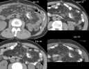 CT abdomen: axial images through dominant tumor mass in left abdomen, comparing 1/13/2005, 4/27/2005, 7/27/2005, and 2/1/2006 at Level One