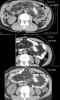 CT abdomen: axial images through dominant tumor mass in left abdomen, comparing 1/13/2005, 7/27/2005, and 2/1/2006 at Level Two