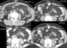 CT Axial images through dominant tumor mass in left abdomen, comparing 1/13/2005, 7/27/2005, and 2/1/2006 at level three