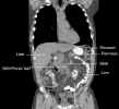 Coronal image through dominant tumor mass in left abdomen 2/1/2006