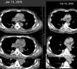 CT thorax: Axial images through right lower lobe lung lesion, comparing 1/13/2005 and 2/1/2006.