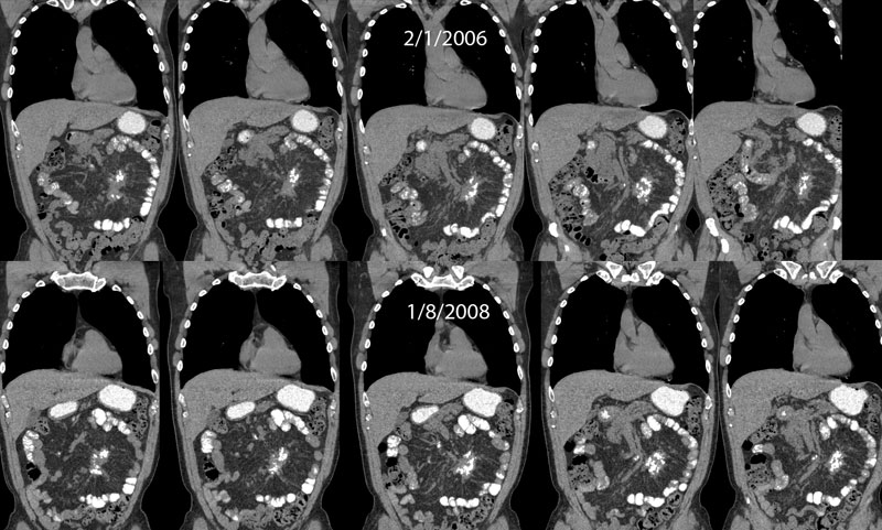 PET/CT 1/13/05 exam, coronal image through tumor