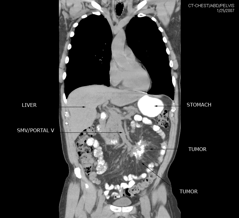 PET/CT 1/13/05 exam, coronal image through tumor